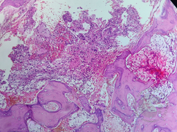 Bone marrow metastasis in prostate carcinoma 1