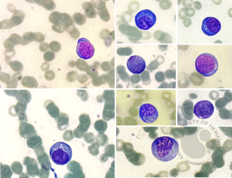 Plasma cell leukemia