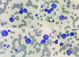 Plasma cell myeloma 1