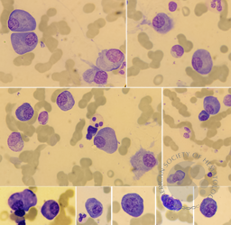 Plasma cell myeloma 2