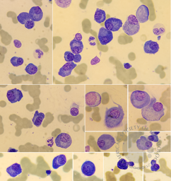 Plasma cell myeloma 4