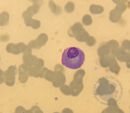 Plasma cell myeloma