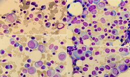 Plasma cell myeloma 2