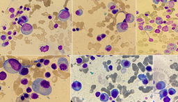 Plasma cell myeloma 3