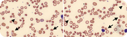 Favism with methemoglobinemia