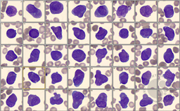 APML with Auer Rods; Flow cytometry 1