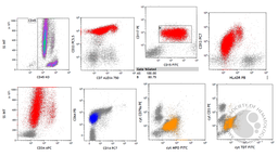 APML with Auer Rods; Flow cytometry 3