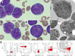 Near early T-precursor lymphoblastic leukemia with marked flower petal nuclei: blast with unique cyanthiform nucleus