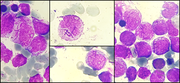 Faggot cells in acute promyelocytic leukemia