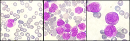 Atypical promyelocytes in AML M3 variant