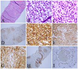 Follicular Lymphoma with Signet Ring-like Cells