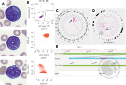 B-cell acute lymphoblastic leukemia with MEF2D::BCL9 rearrangement mimicking a Burkitt lymphoma