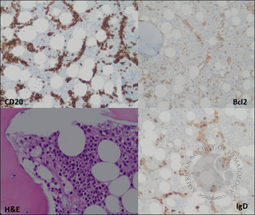 Pseudo Auer rods in Splenic marginal zone lymphoma. 2