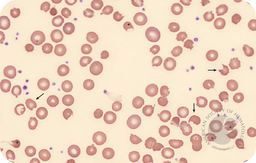 Oxidative hemolysis due to phenazopyridine in the absence of G6PD deficiency