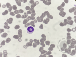 Ring neutrophil 1