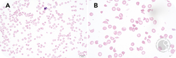 Pancreatitis-associated thrombotic microangiopathic hematolytic anemia with thrombocytopenia in a child