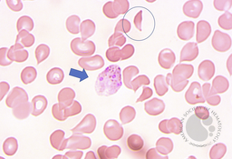 A Hyena cannot spare the feeble: Plasmodium Vivax in a follow up case of Sickle cell Anaemia