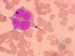 Quadri-nucleated giant proeythroblast in a case of Parvovirus B-19 infection