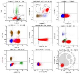 Blastic plasmacytoid dendritic cell neoplasm (BPDCN) 2