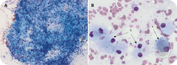 Bone marrow Gaucheromas