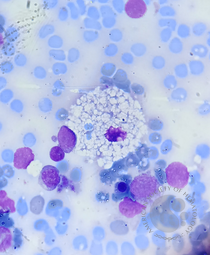 Niemann–Pick disease