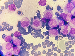 Acute monocytic leukemia 2