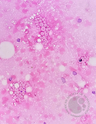 CRYPTOCOCCUS, FNAC Abdominal LN