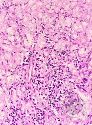 CRYPTOCOCCUS, Abdominal LN, H&E 400X