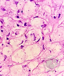 CRYPTOCOCCUS, Abdominal LN, H&E Oil immersion