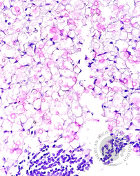 CRYPTOCOCCUS, Abdominal LN, Mucicarmine stain 400X