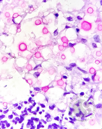 CRYPTOCOCCUS, Abdominal LN, Mucicarmine stain Oil immersion