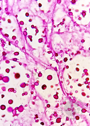 CRYPTOCOCCUS, Abdominal LN, PAS stain
