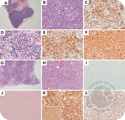 Prominent expansion of EBV large B cells obscuring follicular helper T-cell lymphoma