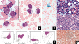 Auer rod–like inclusions in B-cell lymphoma mimicking therapy-related acute myeloid leukemia