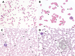 Parvovirus B19-induced autoimmune hemolytic anemia in hereditary elliptocytosis