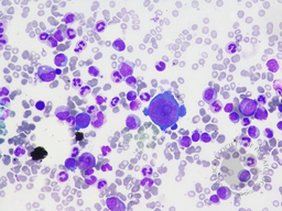 Giant Proerythroblast showing dog ear-like cytoplasmic pseudopodia (due to Parvovirus B19) with Pure red cell aplasia, Bone marrow aspiration