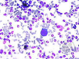 Giant Proerythroblast due to Parvovirus B19 with Pure red cell aplasia, Bone marrow aspiration 1