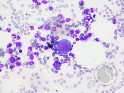 Giant Proerythroblast due to Parvovirus B19 with Pure red cell aplasia, Bone marrow aspiration 2