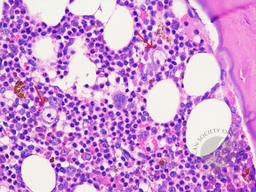 Giant Proerythroblast (GPE) due to Parvovirus B19 with Pure red cell aplasia in bone marrow biopsy. GPE revealed intranuclear inclusions which resembl