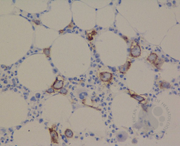 CD71 highlighting Giant Proerythroblast due to Parvovirus B19 with Pure red cell aplasia.