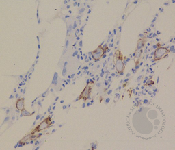 E-cadherin highlighting Giant Proerythroblast due to Parvovirus B19 with Pure red cell aplasia.