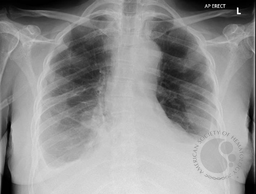 Myeloma patient with bilateral pleural effusion