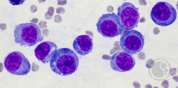 Myeloma EMD in pleural fluid