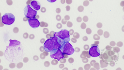 AML with NUP98::HOXA13 fusion and FLT3-ITD