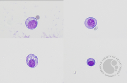 Plasma cells in CSF