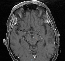 MRI brain shows CNS EMD