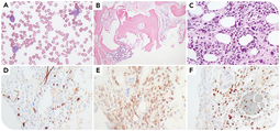 c-MYC stain as a potential minimal residual disease marker for acute myeloid leukemia with NPM1 mutation