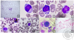 Bone marrow findings in Pearson syndrome