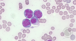 Plasma cell leukemia with anaplastic features