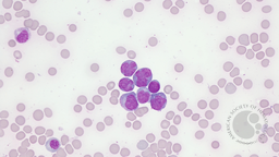 Plasma cell leukemia with anaplastic features